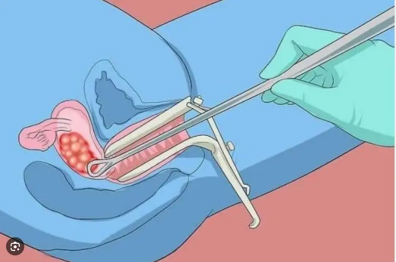 Ưu nhược điểm của việc thắt ống dẫn trứng . Thuốc Phá Thai Tại Nga .
